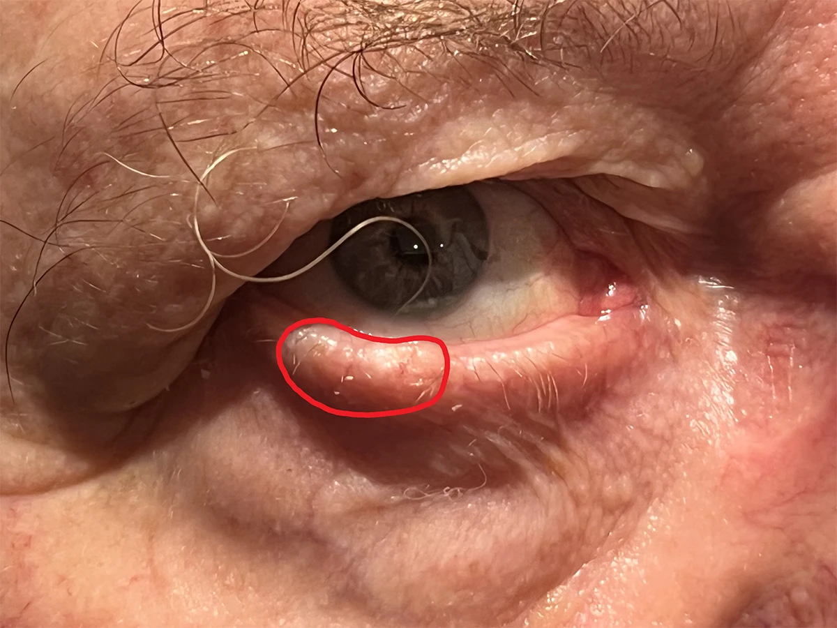 Before skin cancer surgery