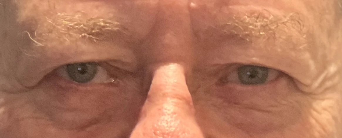 One month after skin cancer surgery